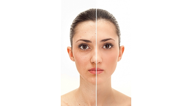 Gözaltı Torbalarınızla Vedalaşmanın İpuçları