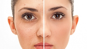 Gözaltı Torbalarınızla Vedalaşmanın İpuçları