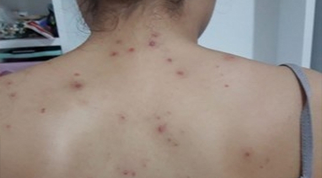 KOVANLARDAN ÇIKAN ARILAR GENÇ KIZA SALDIRDI